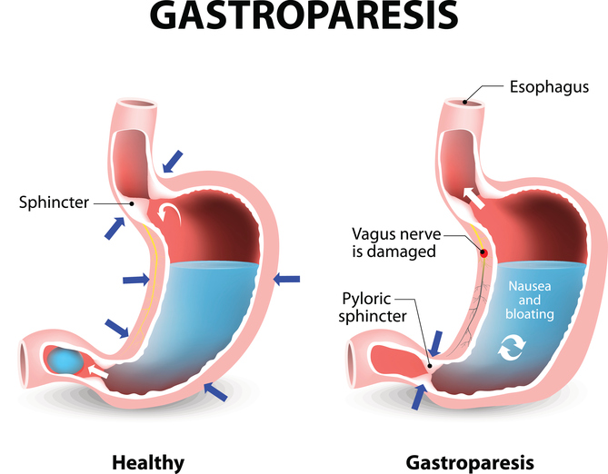 Diagram of stomach in gastroporesis, indicating pyloric sphincter leading to intestine