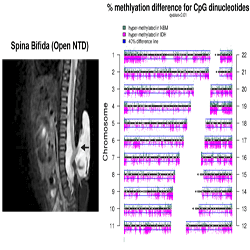 MRI of patient with spina bifida (arrow) MRI of patient with spina bifida (arrow)