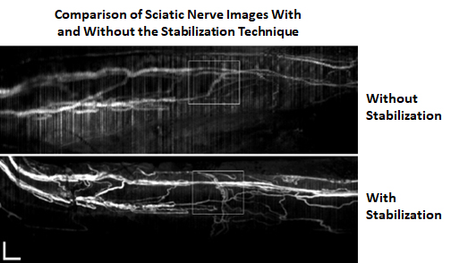 Comparison of sciatic nerve images with and without the stabilization technique