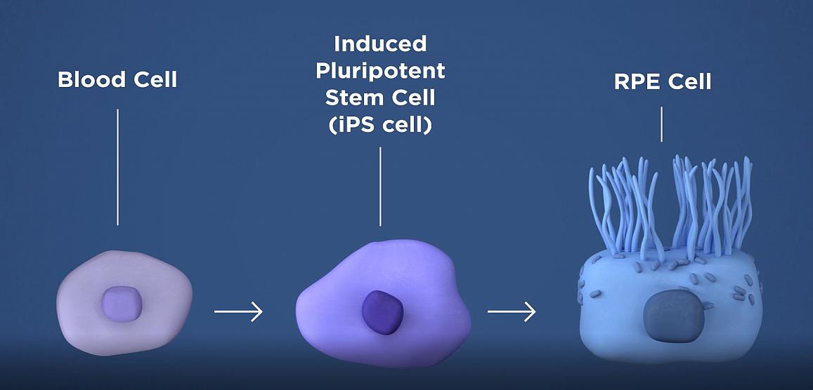 The researchers will take a patient’s own blood cells, and in a lab, convert them into iPS cells capable of becoming any type of cell in the body. The iPS cells are then programmed to become retinal pigment epithelial cells, the type of cell that dies early in the geographic atrophy form of AMD. NEI.