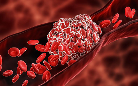 Venous thromboembolism (VTE), a condition where blood clots form inappropriately in the veins, is estimated to affect.