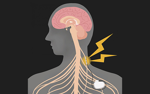 Illustration of vagus nerve stimulation (VNS) device.