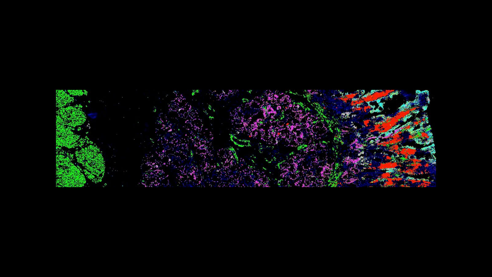 Molecular Cartography image of RNA within polyps from familial adenomatous polyposis patients, courtesy of Dr. Chenchen Zhu at the Snyder Lab at Stanford University