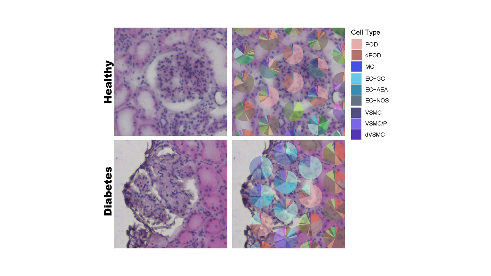 Spatial transcriptomics image of both healthy and diabetic kidneys from Dr. Sanjay Jain's lab at Washington University in St. Louis