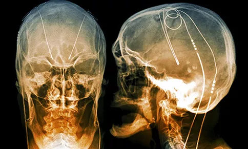 X-rays of a patient with Parkinson's disease show the electrodes of a deep brain stimulator implanted in the brain. This "brain pacemaker" emits electrical impulses to treat the disease's motor symptoms. IMAGE: ZEPHYR/SCIENCE SOURCE