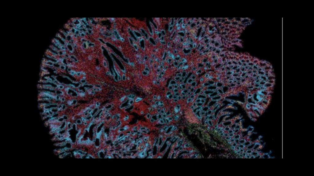 Xenium image of goblet cells and cancer stem-like cells in a section of human intestine