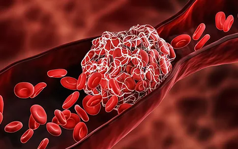 Venous thromboembolism (VTE), a condition where blood clots form inappropriately in the veins, is estimated to affect.